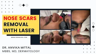 Enlarged oil glands removal from nose with laser ! Nose scars removal !