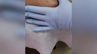 Удаление татуировки сделанной гелевой пастой