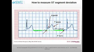 The ECG in myocardial infarction (part I)