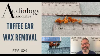 TOFFEE EAR WAX REMOVAL - EP624