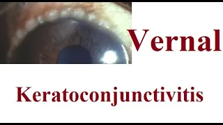 Vernal Keratoconjunctivitis (VKC)