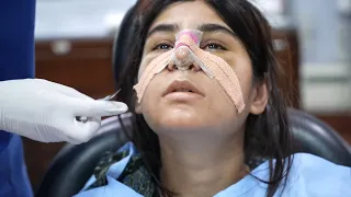 Rhinoplasty - Nose Job Before & After Surgery | Rhinoplasty in India