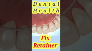 fix Retainer #shorts #tiktok #viral