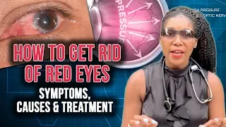 How To Get Rid Of Red Eyes: Top 5 Causes [2020]