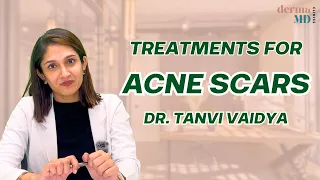 Acne Scars |  Acne Scars Treatments | Acne Marks | How To Treat Acne Scars | Dr Tanvi Vaidya