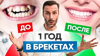 Брекеты До и После – 5 реальных примеров сложных работ в клинике OrthoLike