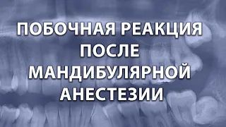 Побочная реакция после мандибулярной анестезии.