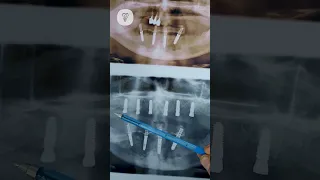 Разбор на рентгене. Поставили 6 имплантатов. Имплантация зубов.