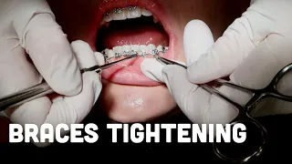 Getting my braces tightened/adjusted appointment - what happens step by step