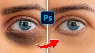 How to Remove Dark Circles Naturally in 1 Minutes