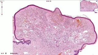 Capillary Hemangioma - Skin, Histopathology