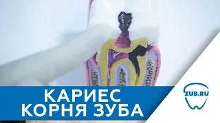 Кариес корня зуба. Лечение кариеса корня зуба