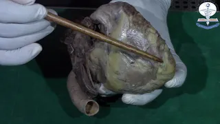 Cadaveric Demonstration Heart - Dr Hasitha Dissanayake