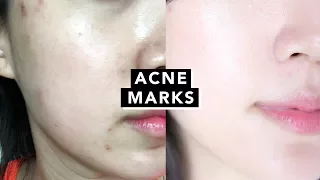 How I Got Rid of Acne Marks • Hyperpigmentation with $15