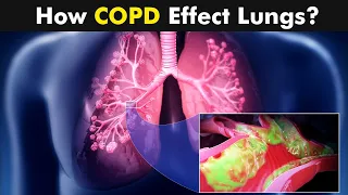 Chronic Obstructive Pulmonary Disease (COPD) | Symptoms, Causes And Treatment (Urdu/Hindi)