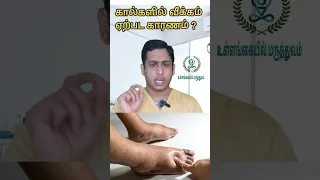 கால்களில் வீக்கம் ஏற்பட காரணம்|Ankle swelling causes|Foot swelling reasons|Pedal edema Causes tamil