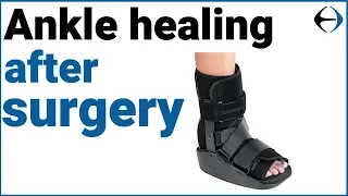 Ankle Surgery: How long does it take for your ankle to heal after surgery?