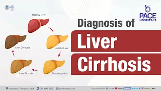 Diagnosis of Liver Cirrhosis | PACE Hospitals #shortvideo #livercirrhosis