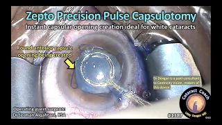 CataractCoach 1387: zepto precision pulse capsulotomy