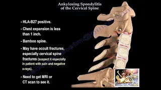 Ankylosing Spondylitis Of The Cervical Spine - Everything You Need To Know - Dr. Nabil Ebraheim