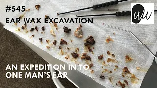 545 - Ear Wax Excavation: An Expedition into One Man's Ear