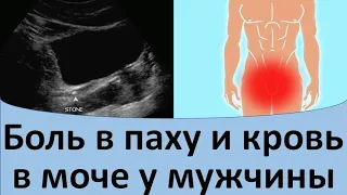 Боль в паху и кровь в моче у мужчины