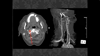 Approach to the small cervical carotid    HD 1080p