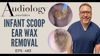 INFANT SCOOP, JOBSON HORNE & SUCTION EAR WAX REMOVAL - EP483