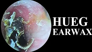 SATISFYING VIDEOS OF EAR WAX REMOVAL ASMR#295🧐#asmr #earpicking