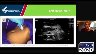 Ultrasound for Pelvic Venous Disorders