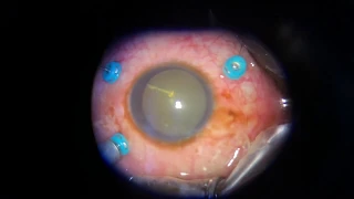 RETINA: Vitrectomy for Vitreous haemorhage from Proliferative Sickle Cell Retinopathy