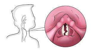 The 4 Underlying Causes of a Hoarse Voice
