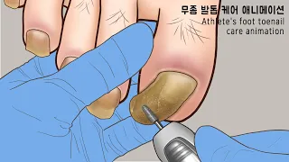 ASMR 속이 뻥 뚫리는! 오래된 무좀 발톱 케어 애니메이션 | Athlete's foot treatment animation