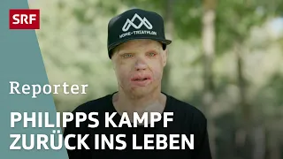 Vom Brandopfer zum Triathlet - Philipp kämpft sich ins Leben zurück | Reportage | SRF