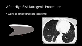 Managing Pneumothorax on Chest Radiographs