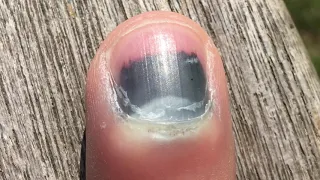 Fingernail Time Lapse (4 Month Recovery!)