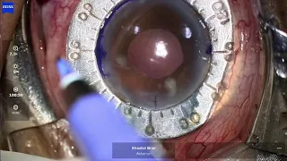 Yamane Technique of Intrascleral Haptic Fixation -Dr Sheetal Brar