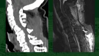 Cervical Spine Clearance in the Traumatically Injured Patient: Is CT Scan Sufficient Alone