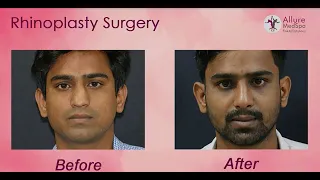 Happy Patient Testimonials about Rhinoplasty:Crooked Nose Reshaping Surgery by Dr. Milan Doshi