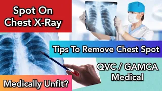 QVC Medical |💥How To Remove Chest X-Ray Spot| Part-2