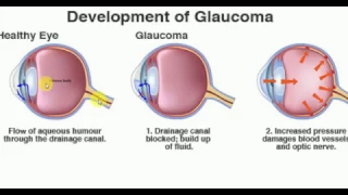 OPTHALMOLOGY GLAUCOMA  PART 1 BASICS Drainage of aqueous humour