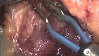 Laparoscopic Spleen-Sparing Subtotal Pancreatectomy