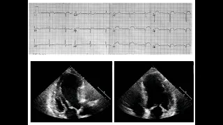 ECG course: Unresolving ST elevation after STEMI, Dr. Sherif Altoukhy