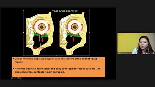 Orbital and Optic Canal Fractures- Dr. Kasturi Bhattacharjee