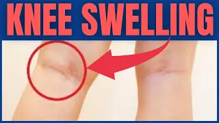 Causes & Treatment of Swelling Behind The Knees