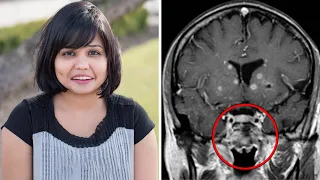 Doctor Finds Unborn Twin Living Inside Of Woman's Brain