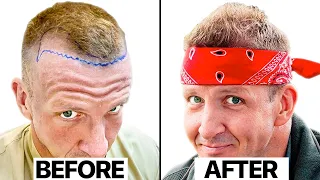 $3,000 Thai Hair Transplant Mistake? Surgeon Reacts