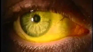 Instilling Fluorescein Dye in the Eye