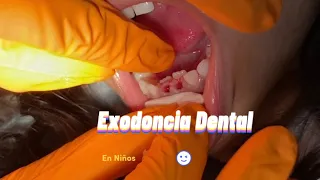 Exodoncia de dientes primarios • Extracción dientes deciduos • sacando dientes de leche