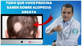 Entenda tudo sobre alopecia areata!